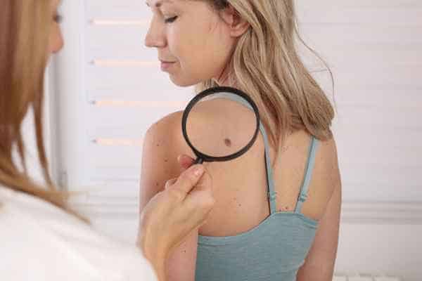 What Are Traditional Skin Lesion Removal Methods Lymington?