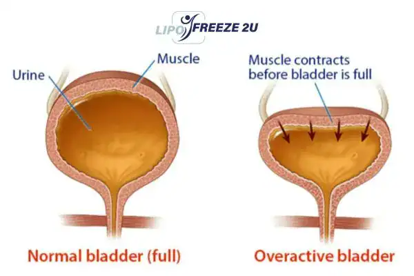 diagram of overactive bladder treatment Lymington