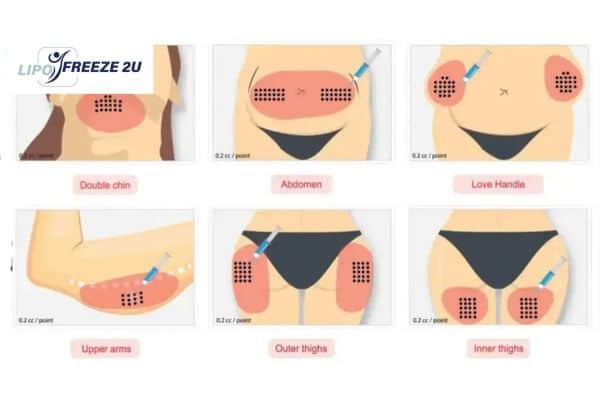 Benefits of Choosing Aqualyx for Fat Reduction Lymington