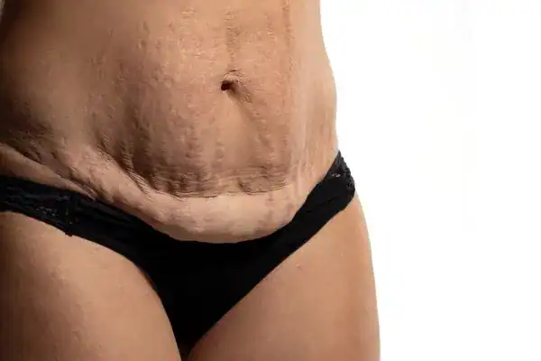 loose skin after weight loss injections Lymington
