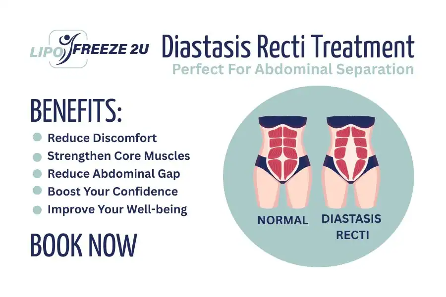 Benefits of body toning treatment Lymington for Diastasis recti