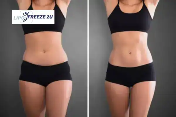 How Can LIPO FREEZE 2U Support Your Post-Pregnancy Body Recovery Lymington?