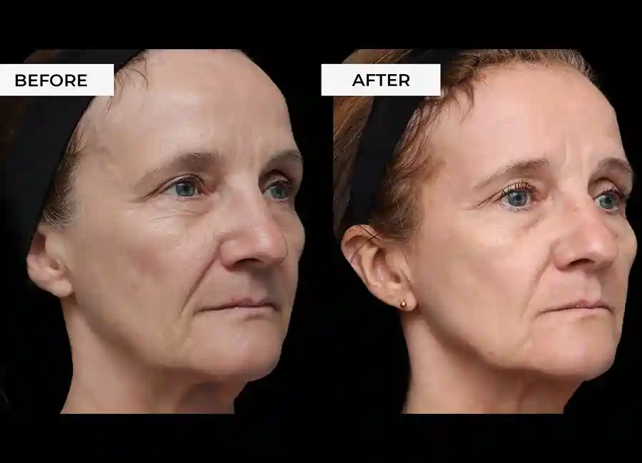 How Many RF Microneedling Sessions Will You Need to See a Difference Lymington?