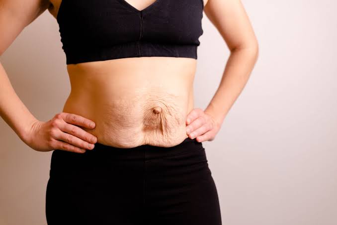 Is Surgery Really the Only Way to Repair Diastasis Recti Lymington?