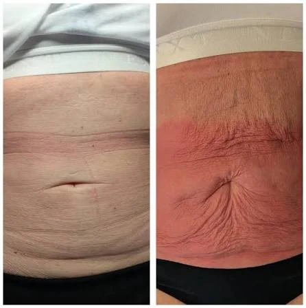 How Does RF Microneedling Improve Crepey, Thin and Uneven Skin Texture Lymington?