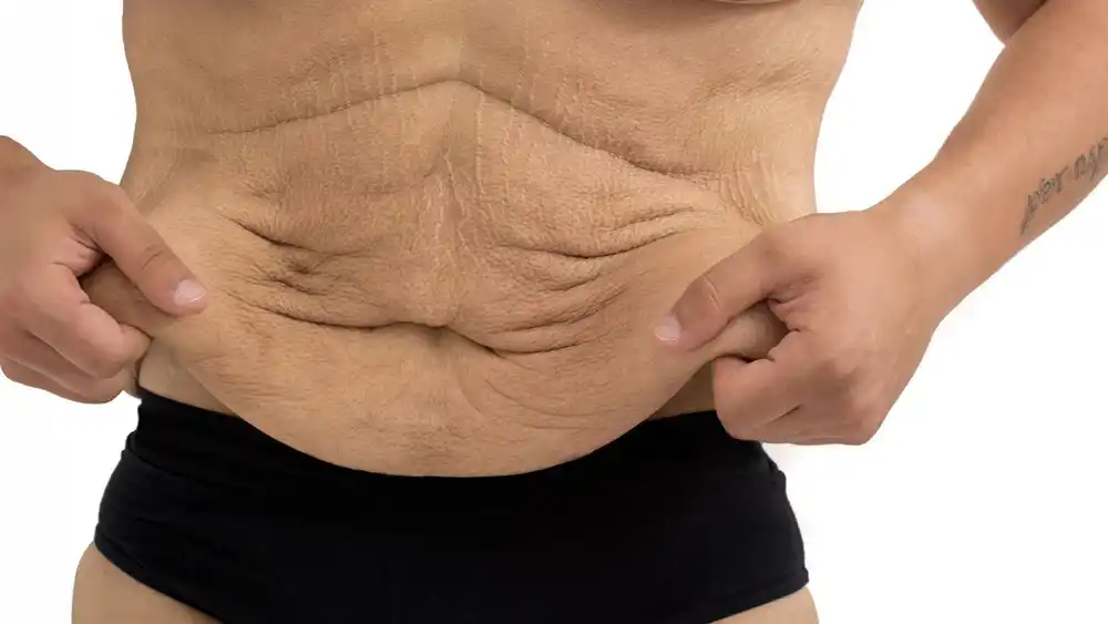 RF Microneedling for Loose Skin: How Can It Help Tighten and Reshape the Skin Lymington?